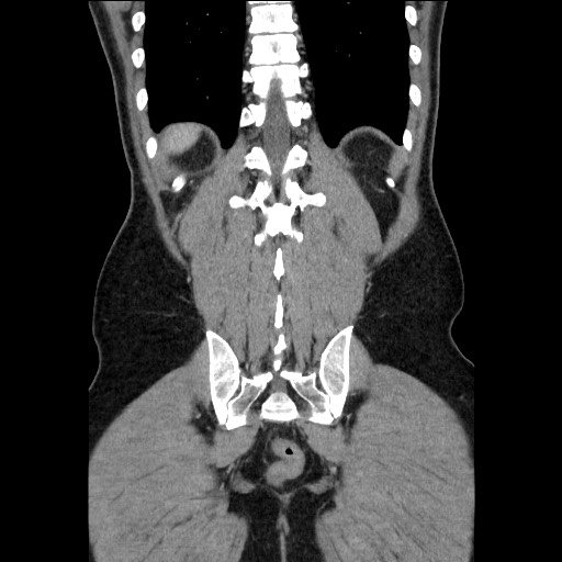 Closed-loop small bowel obstruction (Radiopaedia 73713-84509 C 102).jpg