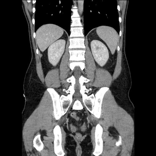 File:Closed-loop small bowel obstruction (Radiopaedia 73713-84509 C 89).jpg