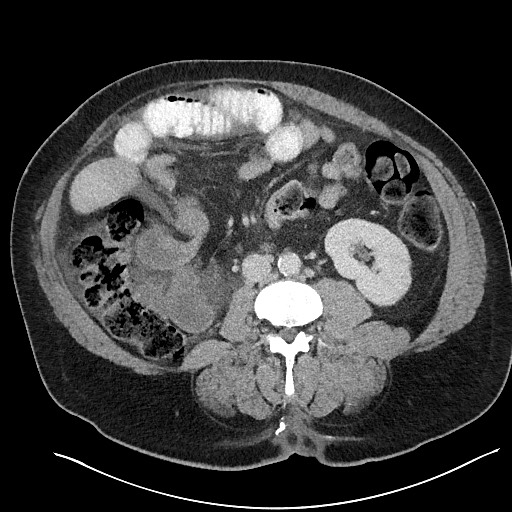 File:Closed loop obstruction - internal hernia into nephrectomy bed (Radiopaedia 59867-67320 A 75).jpg