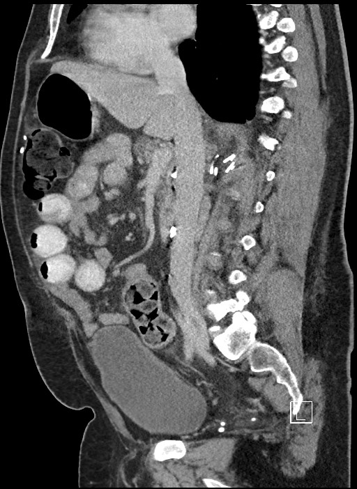 Closed loop obstruction - internal hernia into nephrectomy bed (Radiopaedia 59867-67320 C 54).jpg