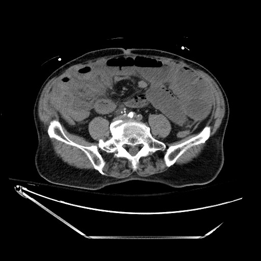 File:Closed loop obstruction due to adhesive band, resulting in small bowel ischemia and resection (Radiopaedia 83835-99023 Axial non-contrast 99).jpg