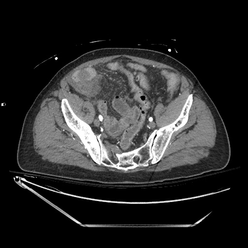 Closed loop obstruction due to adhesive band, resulting in small bowel ischemia and resection (Radiopaedia 83835-99023 B 123).jpg