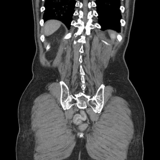 Closed loop obstruction due to adhesive band, resulting in small bowel ischemia and resection (Radiopaedia 83835-99023 C 105).jpg
