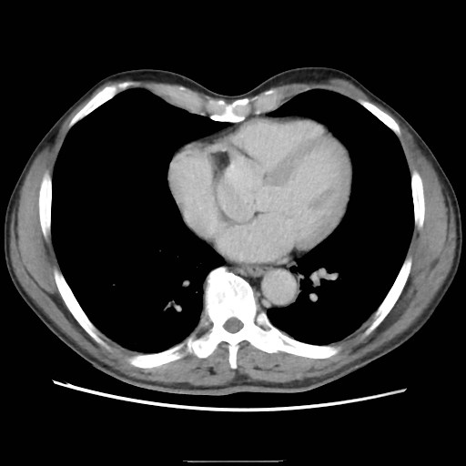 File:Closed loop small bowel obstruction (Radiopaedia 59227-66554 A 9).jpg