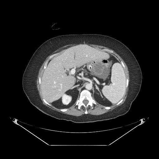 File:Closed loop small bowel obstruction - internal hernia (Radiopaedia 65402-74450 A 30).jpg