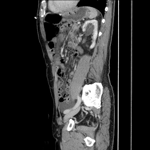 File:Closed loop small bowel obstruction - omental adhesion causing "internal hernia" (Radiopaedia 85129-100682 C 120).jpg