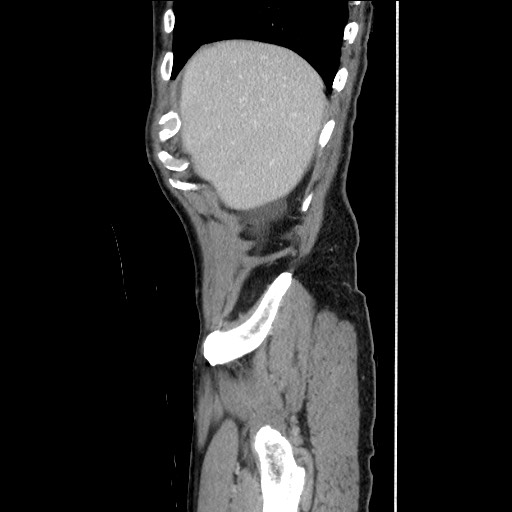 File:Closed loop small bowel obstruction - omental adhesion causing "internal hernia" (Radiopaedia 85129-100682 C 37).jpg