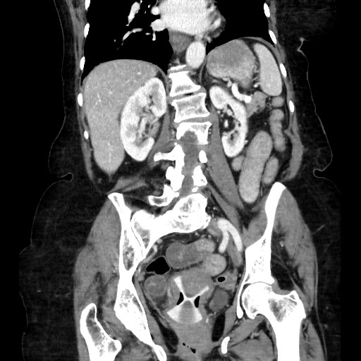 File:Closed loop small bowel obstruction due to adhesive band, with intramural hemorrhage and ischemia (Radiopaedia 83831-99017 C 79).jpg