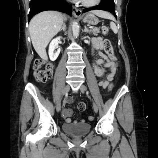 Closed loop small bowel obstruction due to adhesive bands - early and late images (Radiopaedia 83830-99014 B 70).jpg