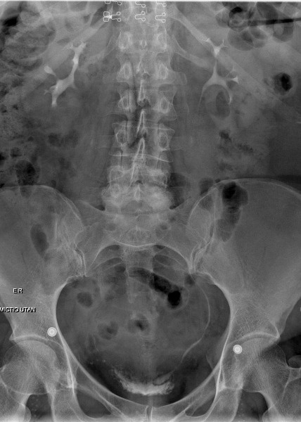 File:Cobra head sign - intravenous urogram (Radiopaedia 46539-50992 E 1).jpg