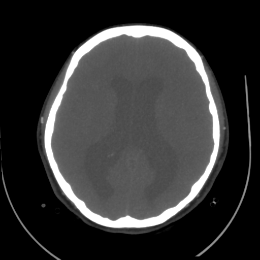 File:Colloid cyst (resulting in death) (Radiopaedia 33423-34499 A 33).png