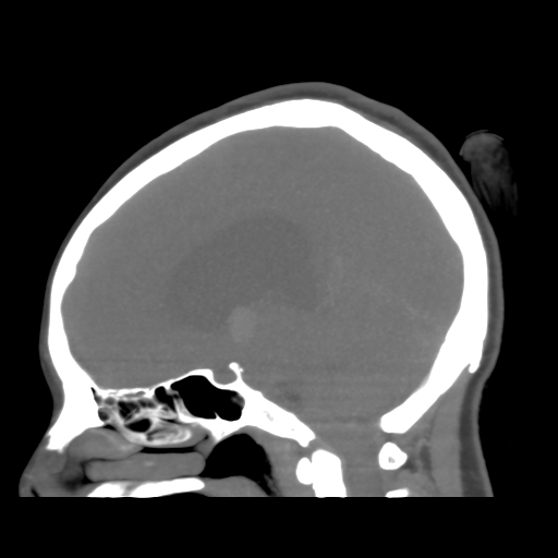 File:Colloid cyst (resulting in death) (Radiopaedia 33423-34499 B 27).png