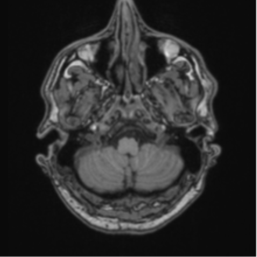 File:Colloid cyst of the third ventricle (Radiopaedia 86571-102662 Axial T1 15).png