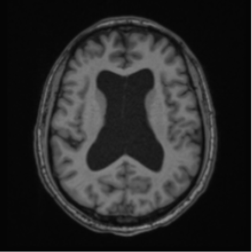File:Colloid cyst of the third ventricle (Radiopaedia 86571-102662 Axial T1 46).png