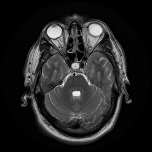 File:Colloid cyst with anterior communicating artery aneurysm (Radiopaedia 33901-35091 Axial T2 7).jpg