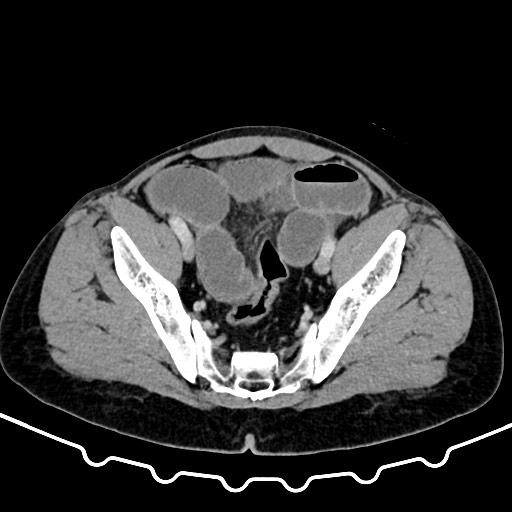 File:Colocolic intussusception due to large lipoma (Radiopaedia 68773-78482 A 160).jpg