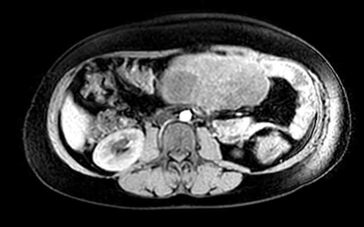 Colon adenocarcinoma with Krukenberg tumors, advanced pregnancy (Radiopaedia 67279-76645 A 46).jpg