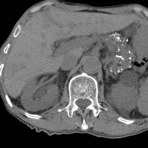Colon cancer with calcified liver metastasis (Radiopaedia 74423-85309 Axial non-contrast 28).jpg
