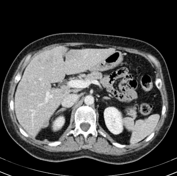 Colon carcinoma with hepatic metastases (Radiopaedia 29477-29961 A 34).jpg