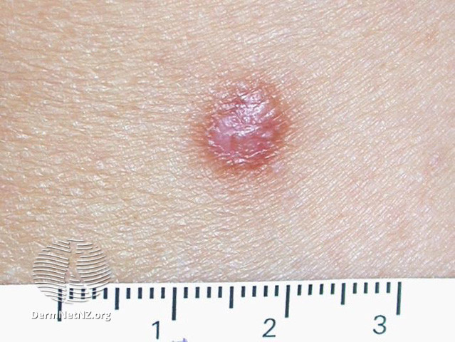 File:Dermatofibroma (DermNet NZ lesions-dermatofibroma-2399).jpg