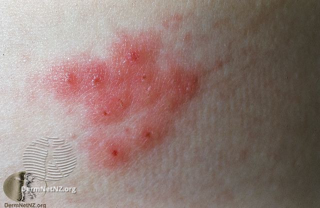 File:Herpes simplex (DermNet NZ 2876).jpg