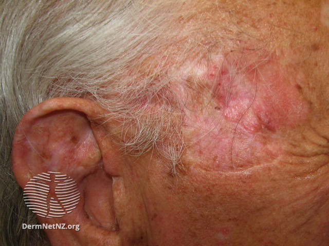 File:Intraepidermal carcinoma (DermNet NZ lesions-scc-in-situ-2956).jpg