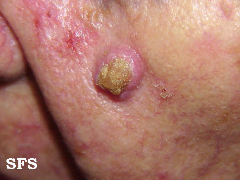File:Keratoacanthoma (Dermatology Atlas 9).jpg