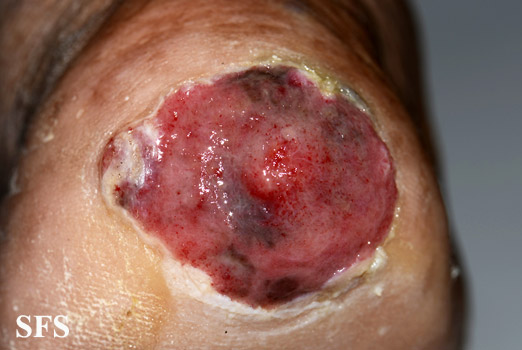 File:Melanoma (Dermatology Atlas 82).jpg
