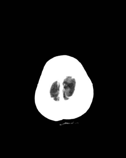 Nasopharyngeal carcinoma with cerebral abscess (Radiopaedia 43018-46275 Axial C+ delayed 48).png