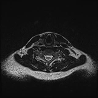 Nasopharyngeal carcinoma with perineural spread (Radiopaedia 55030-61380 Axial T2 70).jpg