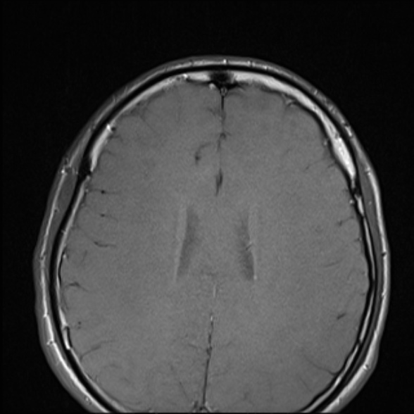Nasopharyngeal carcinoma with skull base invasion (Radiopaedia 53415-59485 Axial T1 1).jpg