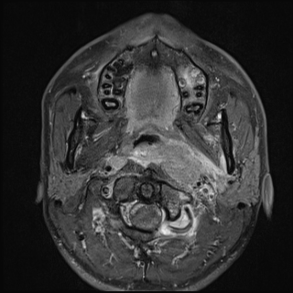 Nasopharyngeal carcinoma with skull base invasion (Radiopaedia 53415-59485 Axial T1 C+ fat sat 33).jpg