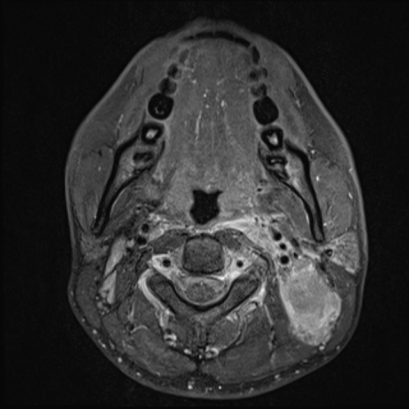 Nasopharyngeal carcinoma with skull base invasion (Radiopaedia 53415-59485 Axial T1 C+ fat sat 41).jpg