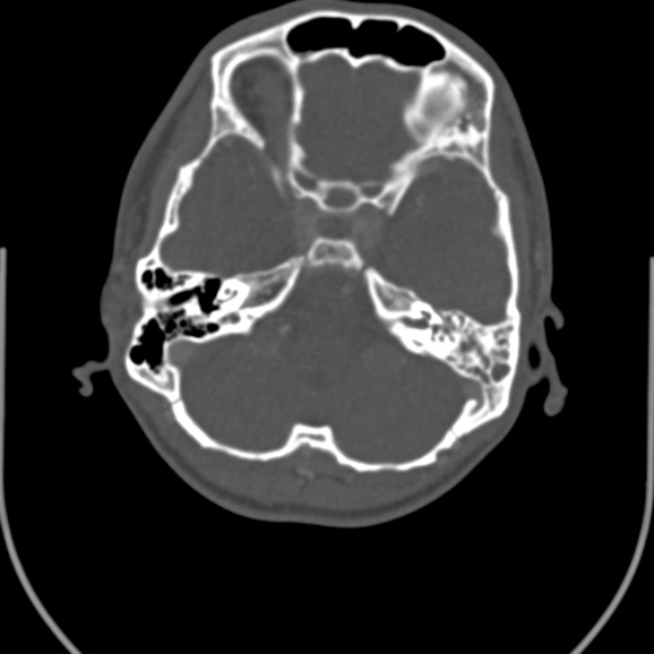 Nasopharyngeal carcinoma with skull base invasion (Radiopaedia 53415-59705 Axial bone window 9).jpg