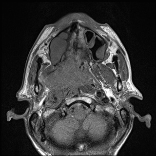 Nasopharyngeal carcinoma with skull base invasion (Radiopaedia 59258-66600 B 22).jpg