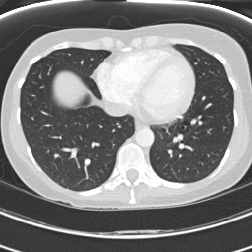 Necrobiotic pulmonary nodules - Crohn disease (Radiopaedia 20723-20631 Axial lung window 102).jpg