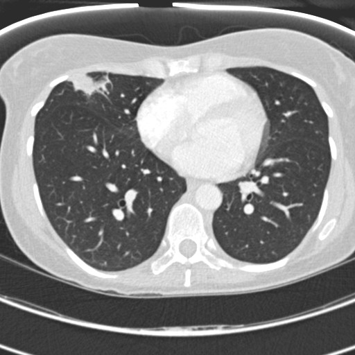 File:Necrobiotic pulmonary nodules - Crohn disease (Radiopaedia 20723-20631 Axial lung window 90).jpg