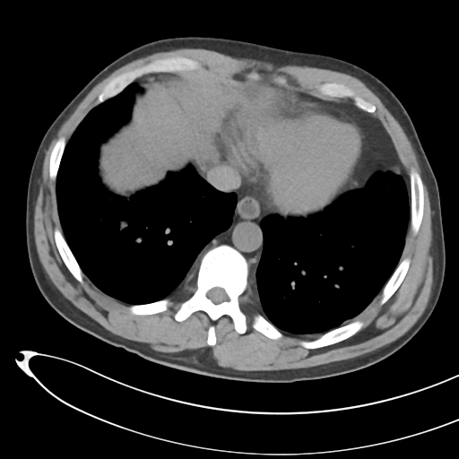 File:Necrotizing pancreatitis with acute necrotic collections (Radiopaedia 38829-41012 Axial non-contrast 8).png