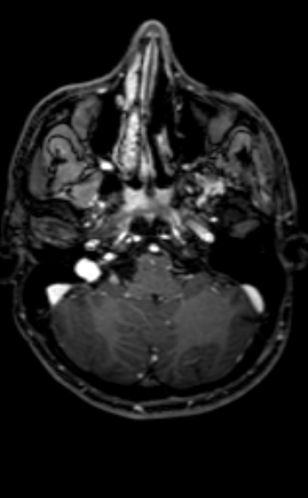 Neuro-Behçet disease (Radiopaedia 90112-107294 Axial T1 C+ 177).jpg