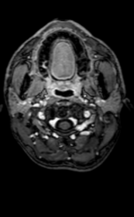 Neuro-Behçet disease (Radiopaedia 90112-107294 Axial T1 C+ 211).jpg