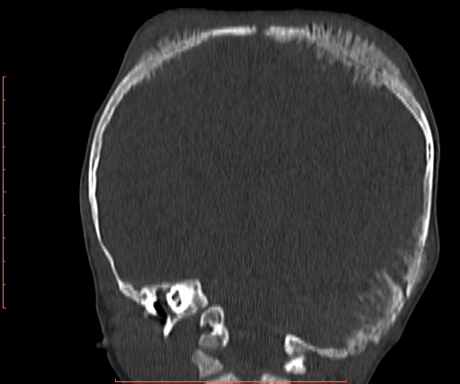 File:Neuroblastoma skull metastasis (Radiopaedia 56053-62683 Coronal bone window 24).jpg