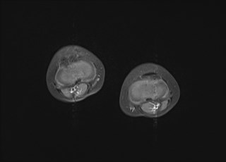 File:Neuroblastoma with bone metastases (Radiopaedia 67080-76414 Axial T1 C+ fat sat 5).jpg