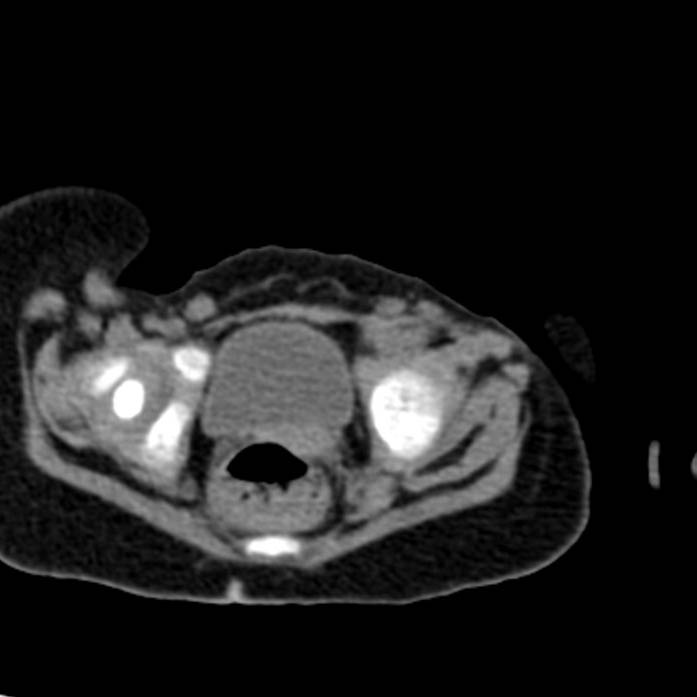 Neuroblastoma with skull metastases (Radiopaedia 30326-30960 Axial non-contrast 57).jpg