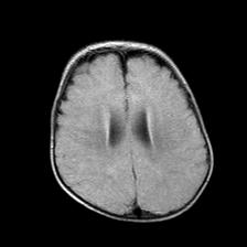 File:Neurofibromatosis type 1 (Radiopaedia 30089-30671 Axial FLAIR 16).jpg