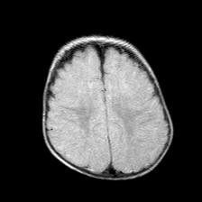 File:Neurofibromatosis type 1 (Radiopaedia 30089-30671 Axial FLAIR 17).jpg