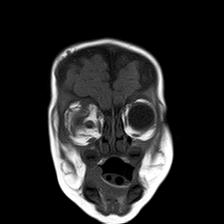 File:Neurofibromatosis type 1 (Radiopaedia 30089-30671 Coronal T1 5).jpg