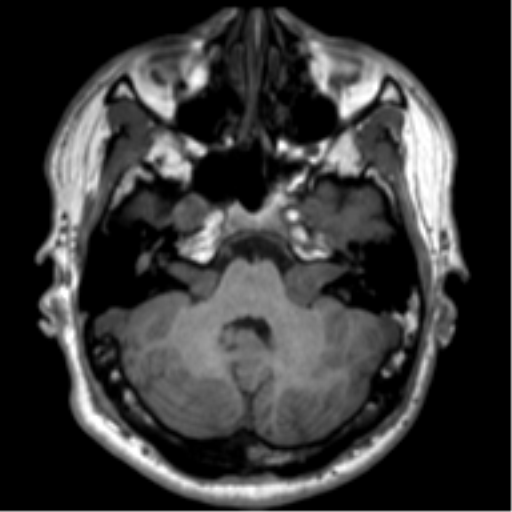 File:Neurofibromatosis type 2 (Radiopaedia 44936-48838 Axial T1 28).png