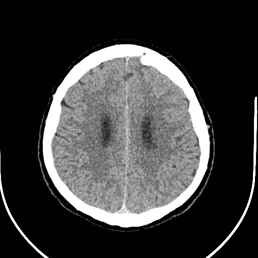Neurofibromatosis type 2 (Radiopaedia 79097-92047 Axial non-contrast 44).jpg