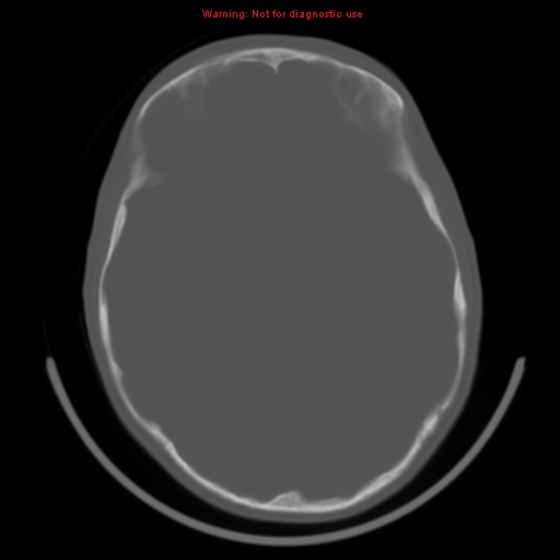 File:Neurofibromatosis type 2 (Radiopaedia 8953-9732 Axial bone window 17).jpg