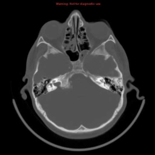 File:Neurofibromatosis type 2 (Radiopaedia 8953-9732 Axial bone window 8).jpg